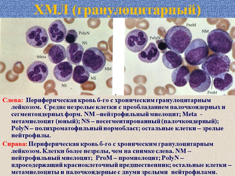 ХМЛ (гранулоцитарный) Слева:  Периферическая кровь б-го с хроническим гранулоцитарным лейкозом.  Средне незрелые